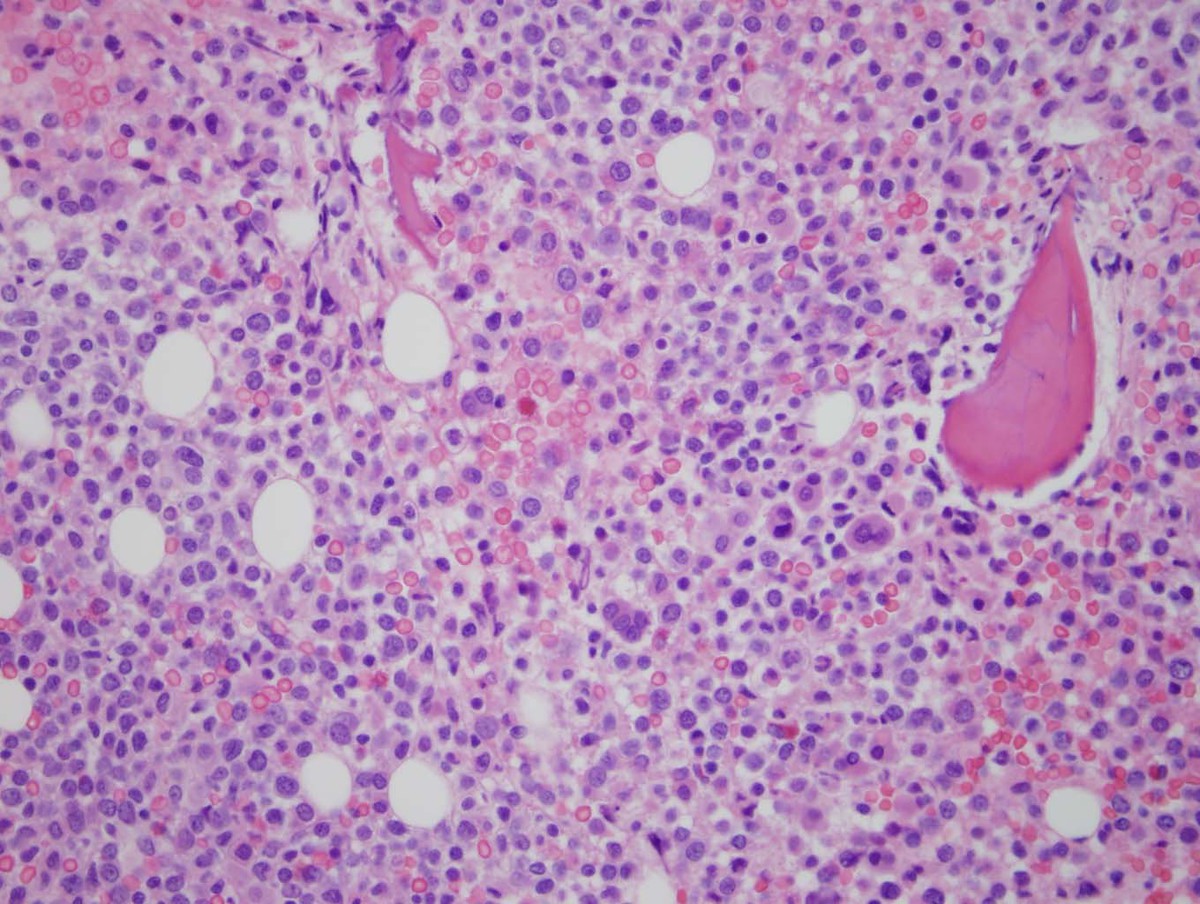 Bone marrow biopsy high power view